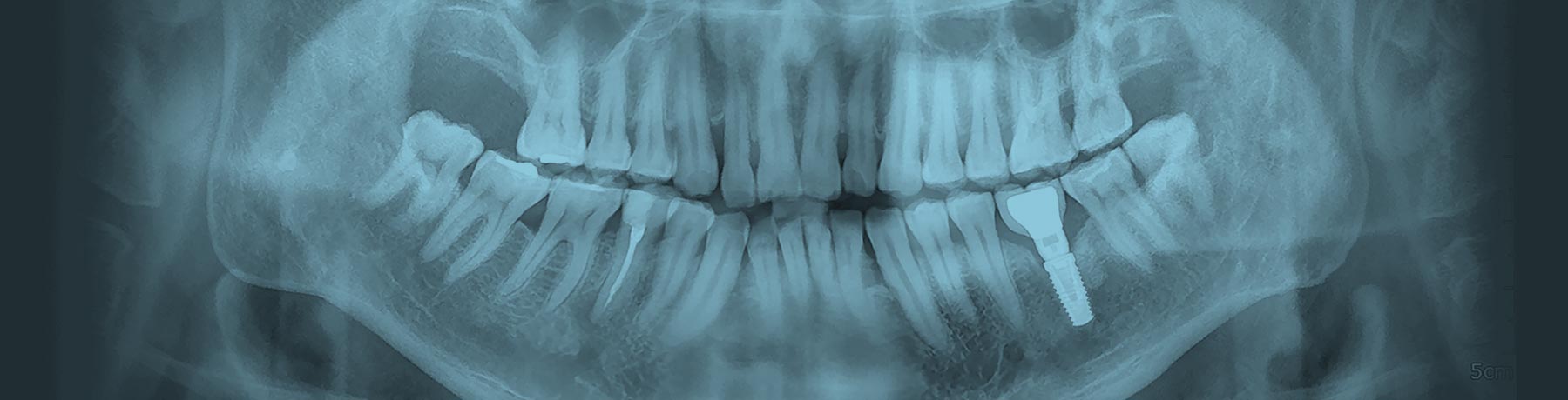 Cannabis Use and Periodontitis In Adults