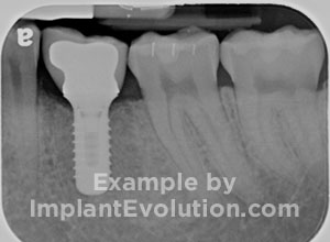 procedure after image Dental Implants procedure after image Dental Implants
