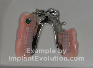 procedure after image Partial Dentures procedure after image Partial Dentures