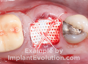 procedure after image Ridge Expansion procedure after image Ridge Expansion
