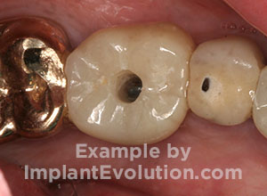 procedure after image Screw Retained Crowns procedure after image Screw Retained Crowns