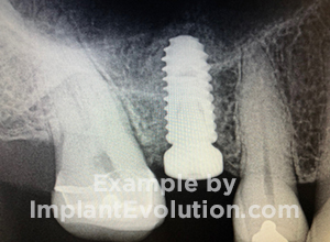 procedure after image Sinus Lift procedure after image Sinus Lift