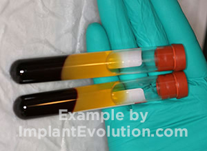procedure before image Bone Grafting procedure before image Bone Grafting