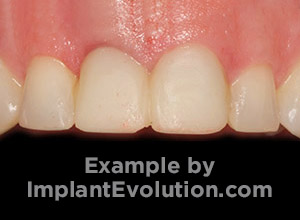 procedure before image Implant Cosmetics procedure before image Implant Cosmetics