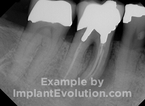 procedure before image Ridge Expansion procedure before image Ridge Expansion