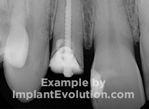 procedure before image Same Day Implants procedure before image Same Day Implants
