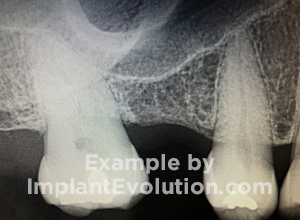 procedure before image Sinus Lift procedure before image Sinus Lift