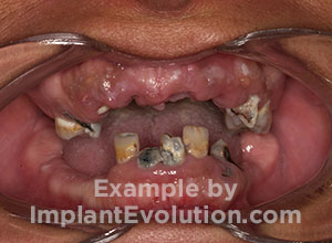 procedure before image Tooth Extractions procedure before image Tooth Extractions