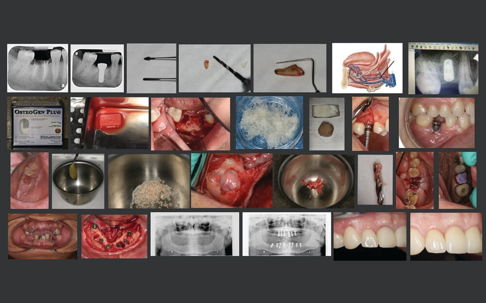 SSI-01 Extractions and Grafting